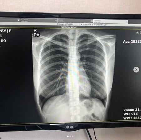 网红胸部作假,美丽背后的秘密