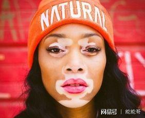 患有白癜风的黑人明星,勇敢面对肌肤异彩人生”
